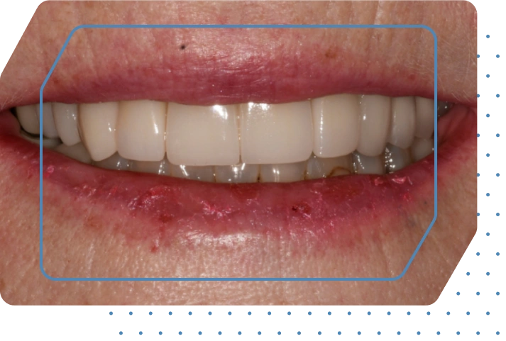 Permanent All-on-4<sup>®</sup> dental implants