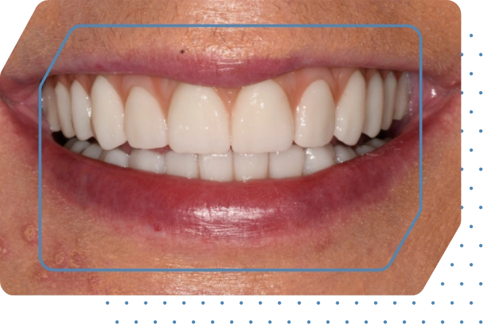 Permanent All-on-4<sup>®</sup> dental implants