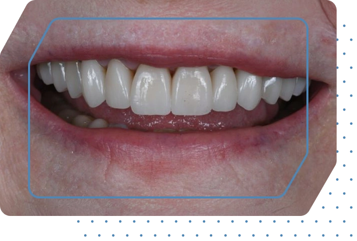 Permanent All-on-4<sup>®</sup> dental implants