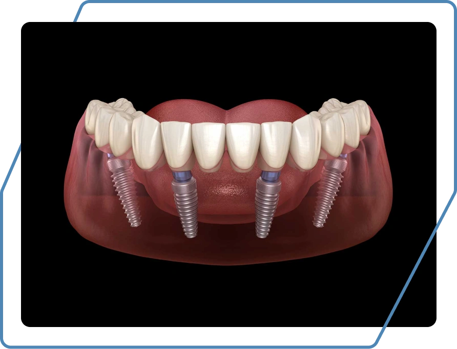 What Are All-On-4<sup>®</sup> Dental Implants?